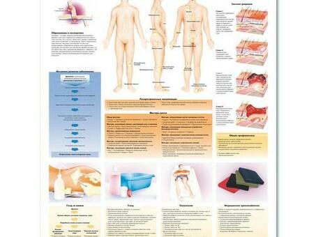 Медицинский плакат "Пролежни"