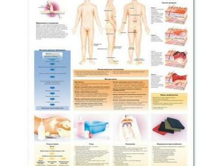 Медицинский плакат "Пролежни"