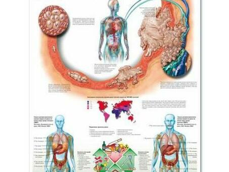 Медицинский плакат "Рак"