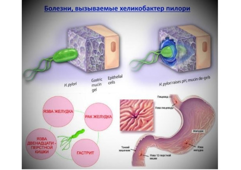 Альтернативное лечение хеликобактер пилори - без антибиотиков