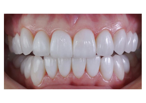 Виниры TruSmile Veneers ????????????