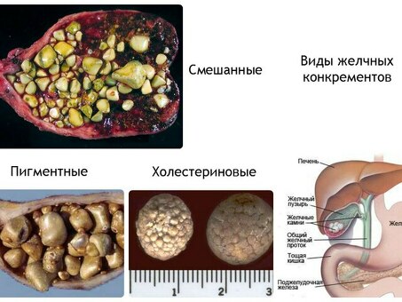 Желчнокаменная болезнь для крупного рогатого скота - купить в интернет-магазине